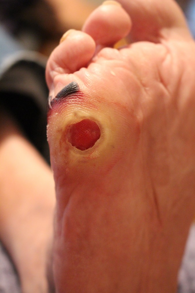 foot at start of honey treatment